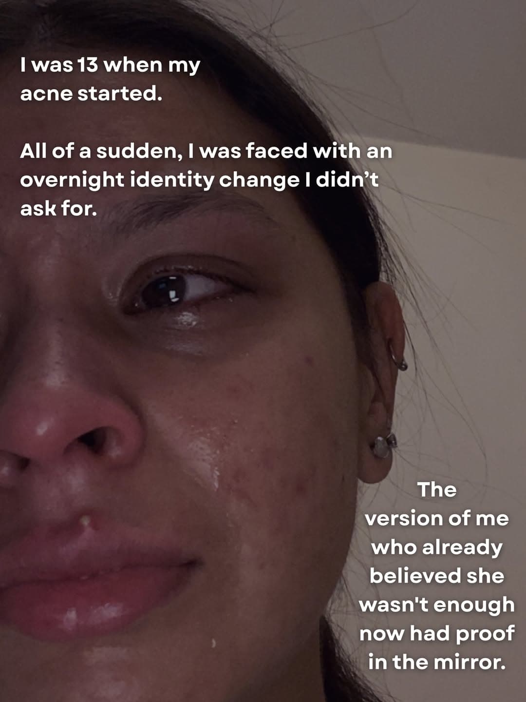 Close-up of Kiara at thirteen with active breakouts and a single tear on her cheek.